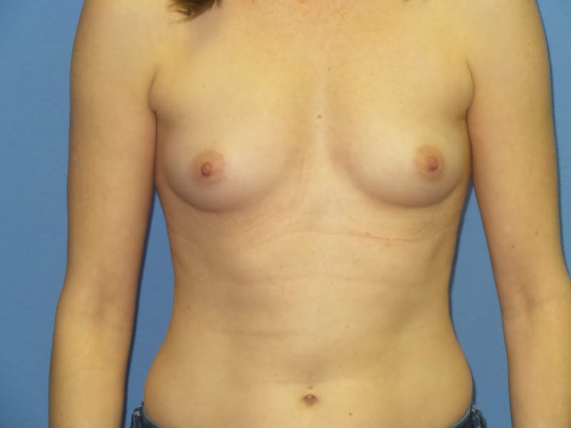 Breast Augmentation Before & After Gallery - Patient 380199 - Image 1