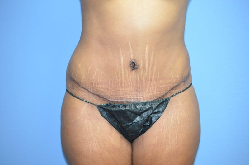 Breast Augmentation + Lift Before & After Gallery - Patient 363065 - Image 6
