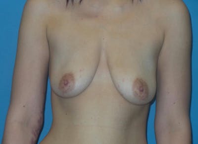 Breast Augmentation + Lift Before & After Gallery - Patient 117831 - Image 1