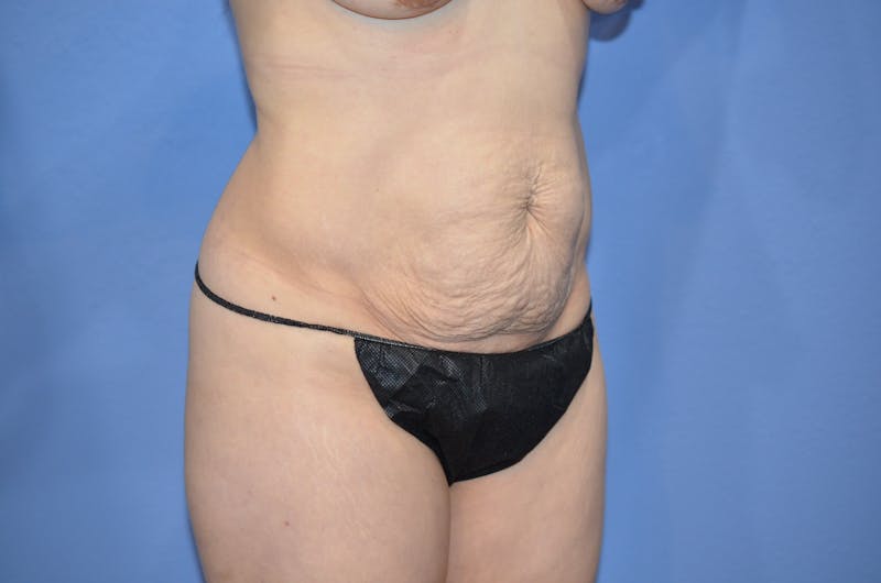 Tummy Tuck Before & After Gallery - Patient 360606 - Image 3
