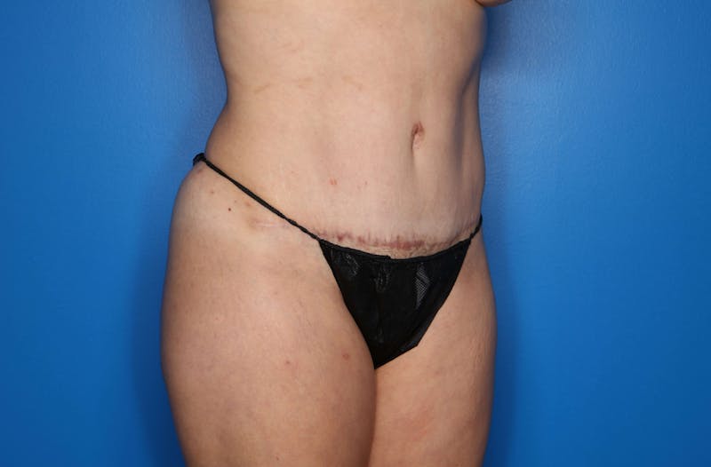 Tummy Tuck Before & After Gallery - Patient 360606 - Image 4