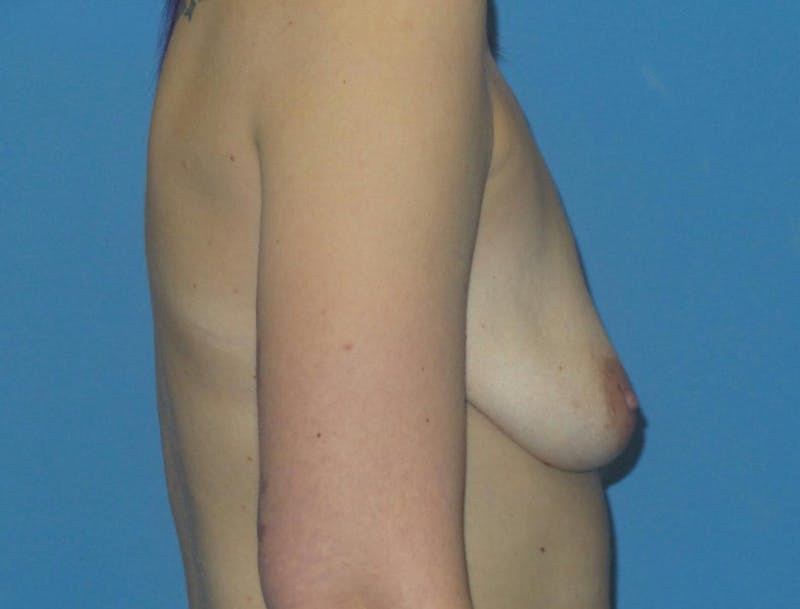 Breast Augmentation + Lift Before & After Gallery - Patient 117831 - Image 3