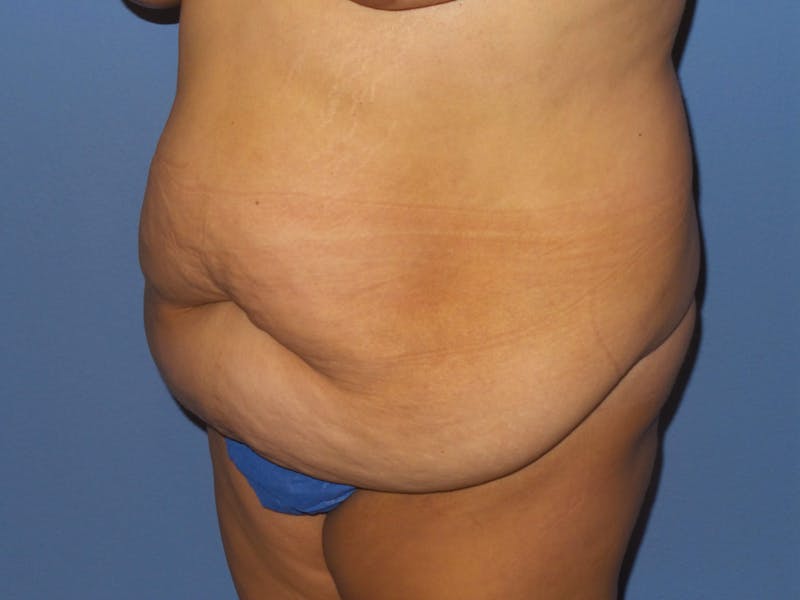 Liposuction Before & After Gallery - Patient 288332 - Image 9