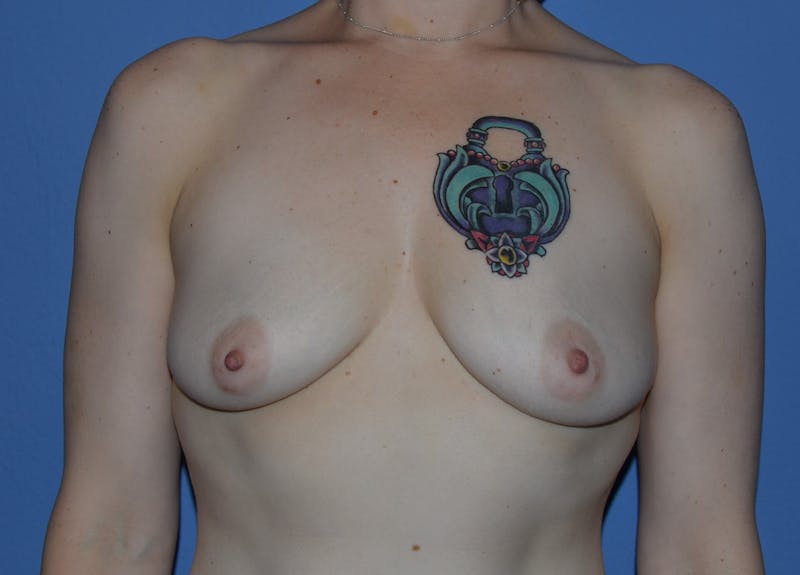 Breast Augmentation Before & After Gallery - Patient 381338 - Image 1