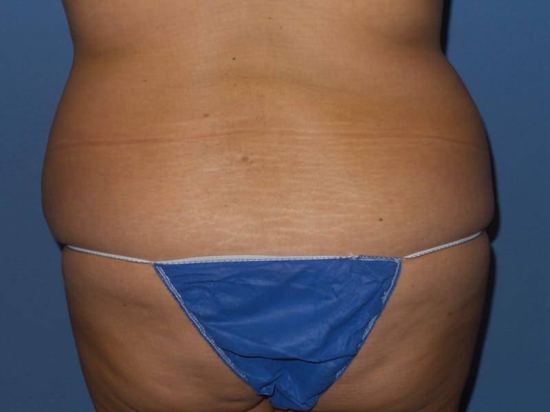Liposuction Before & After Gallery - Patient 288332 - Image 11