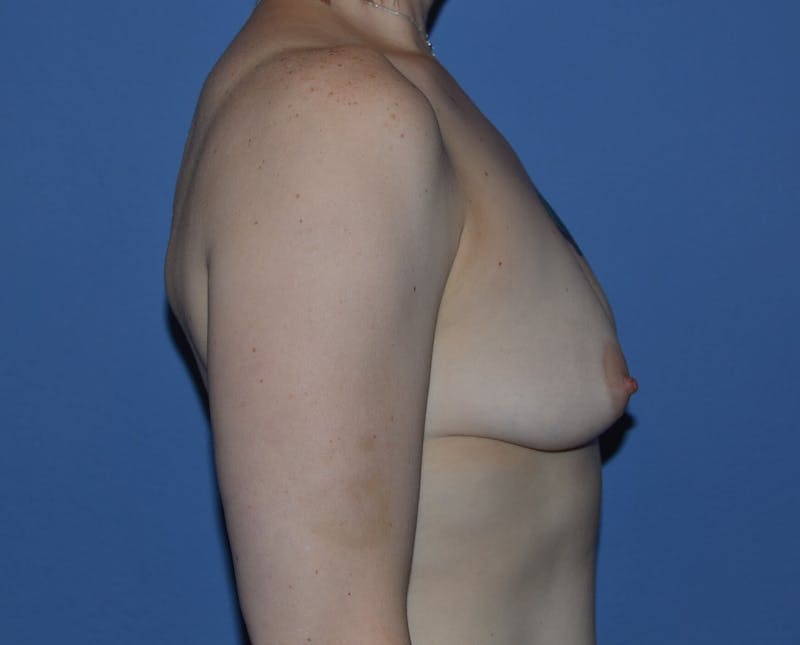 Breast Augmentation Before & After Gallery - Patient 381338 - Image 3