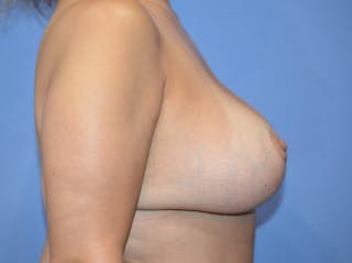 Breast Augmentation + Lift Before & After Gallery - Patient 271099 - Image 6