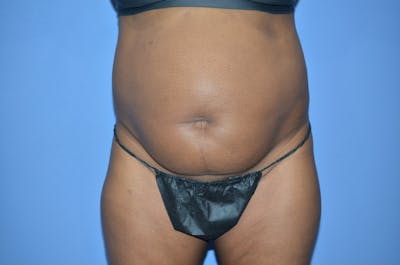 Tummy Tuck Before & After Gallery - Patient 204418 - Image 1