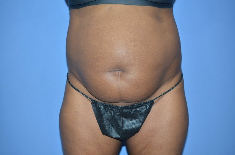 Tummy Tuck Before & After Gallery - Patient 204418 - Image 1