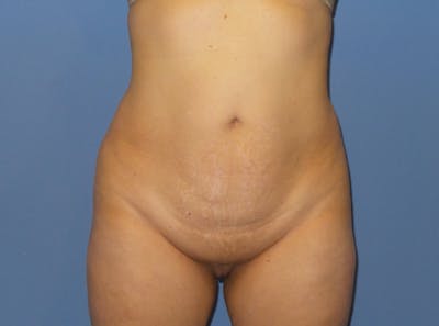 Liposuction Before & After Gallery - Patient 525882 - Image 1