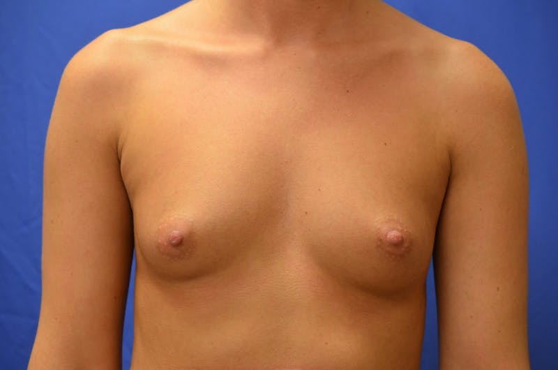 Breast Augmentation Before & After Gallery - Patient 411094 - Image 1
