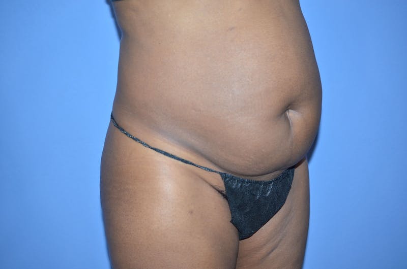 Tummy Tuck Before & After Gallery - Patient 204418 - Image 3
