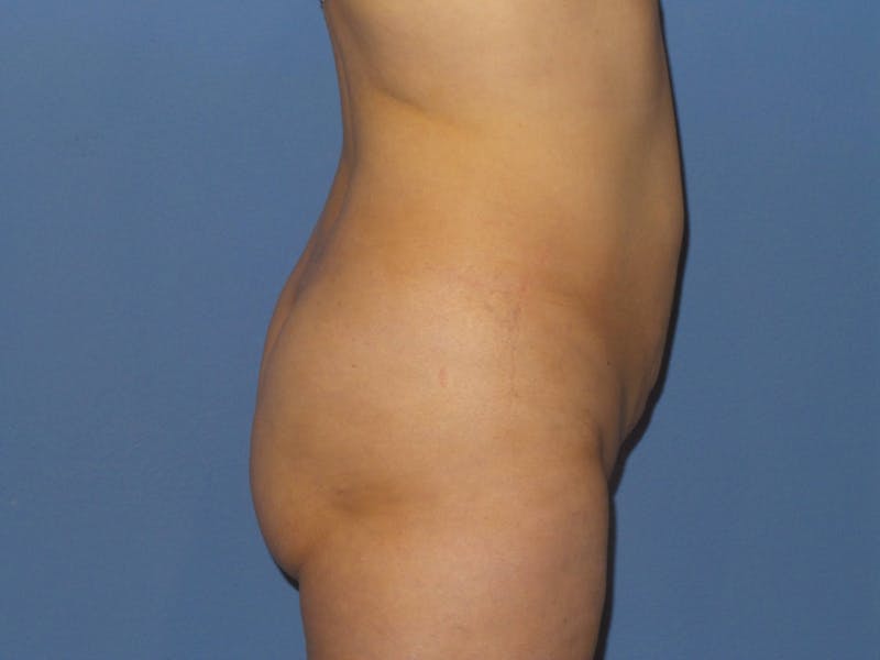 Liposuction Before & After Gallery - Patient 525882 - Image 3