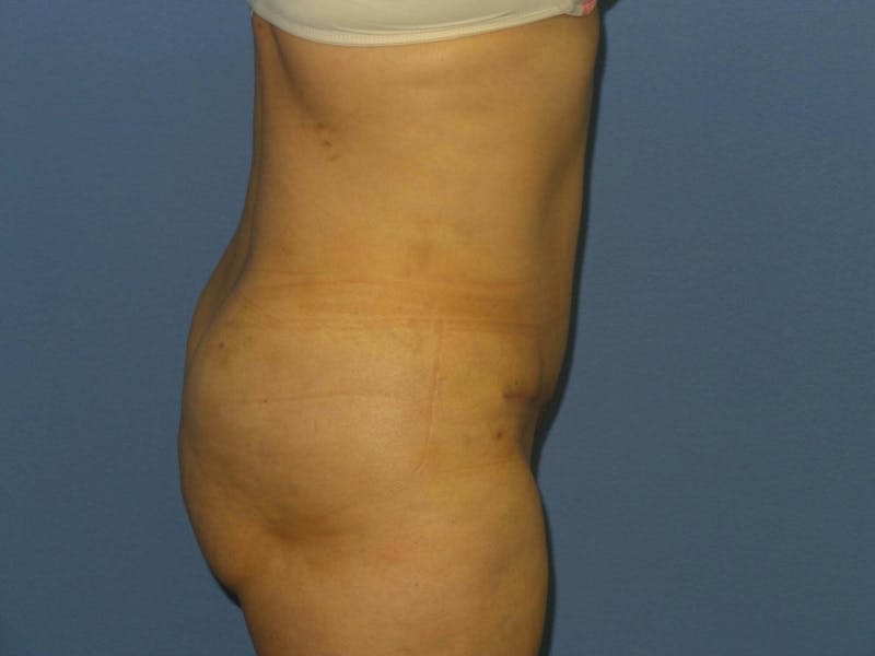 Liposuction Before & After Gallery - Patient 525882 - Image 4