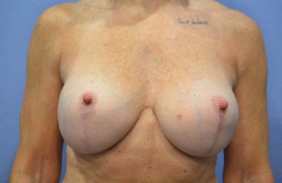 Breast Augmentation + Lift Before & After Gallery - Patient 376698 - Image 2