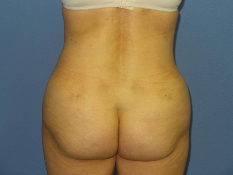 Liposuction Before & After Gallery - Patient 525882 - Image 6
