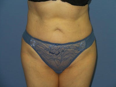 Liposuction Before & After Gallery - Patient 353808 - Image 2