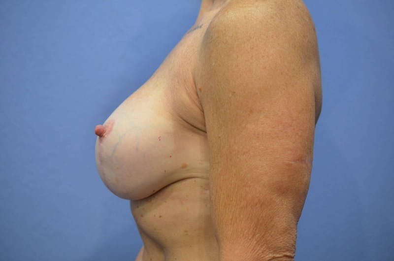 Breast Augmentation + Lift Before & After Gallery - Patient 376698 - Image 6