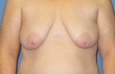 Breast Augmentation + Lift Before & After Gallery - Patient 408146 - Image 1