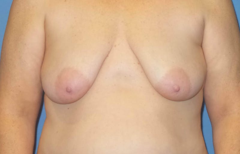 Breast Augmentation + Lift Before & After Gallery - Patient 408146 - Image 1