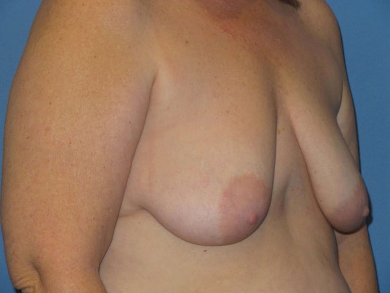 Breast Augmentation + Lift Before & After Gallery - Patient 408146 - Image 3