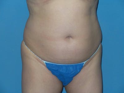 Liposuction Before & After Gallery - Patient 496043 - Image 1