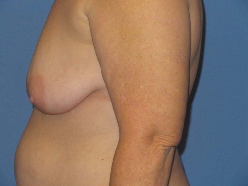 Breast Augmentation + Lift Before & After Gallery - Patient 408146 - Image 5