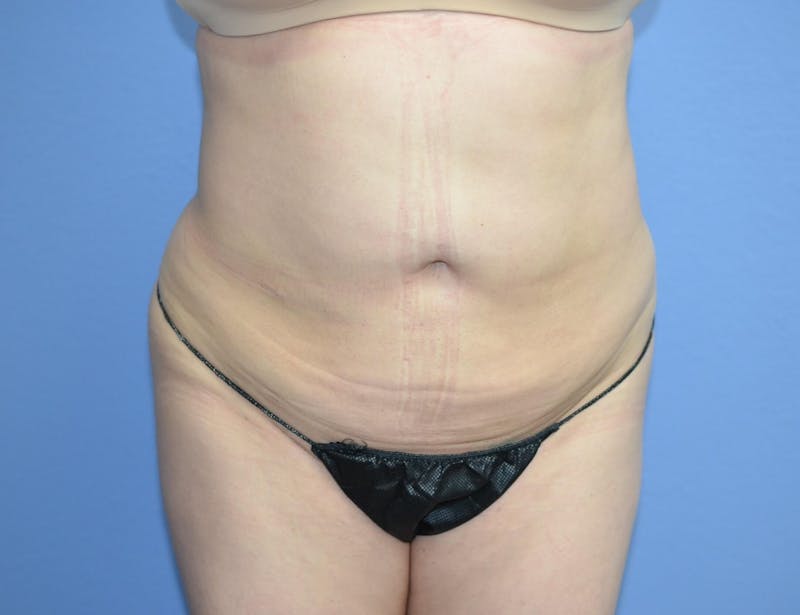 Liposuction Before & After Gallery - Patient 496043 - Image 2