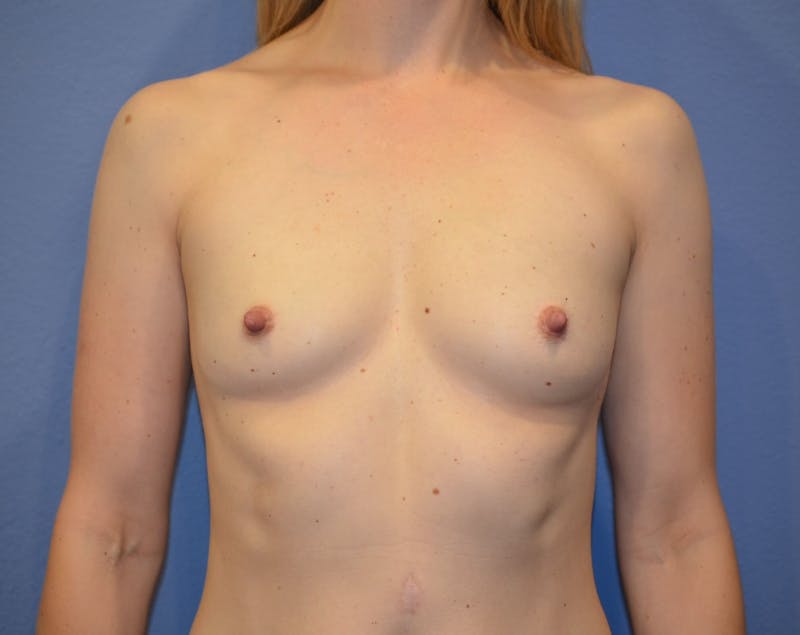 Breast Augmentation Before & After Gallery - Patient 107555 - Image 1