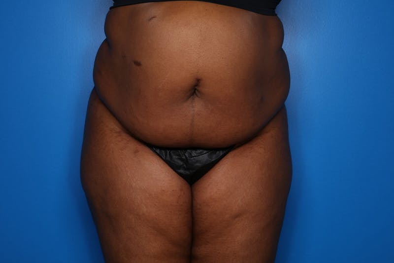 Tummy Tuck Before & After Gallery - Patient 356121 - Image 1