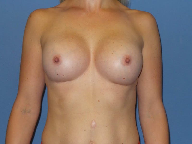 Breast Augmentation Before & After Gallery - Patient 107555 - Image 2