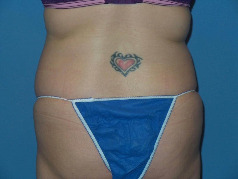 Liposuction Before & After Gallery - Patient 496043 - Image 3