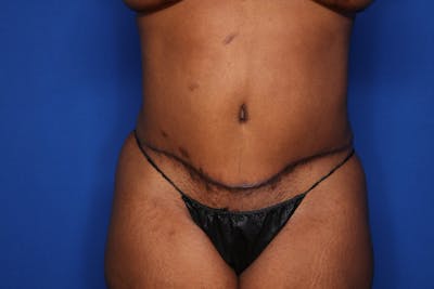 Tummy Tuck Before & After Gallery - Patient 356121 - Image 2