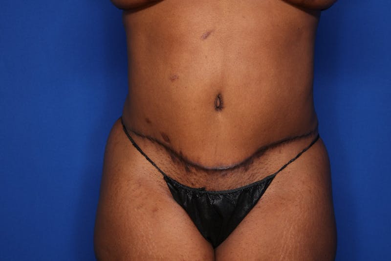 Tummy Tuck Before & After Gallery - Patient 356121 - Image 2