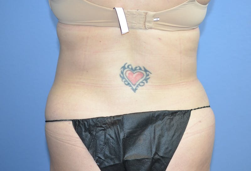 Liposuction Before & After Gallery - Patient 496043 - Image 4