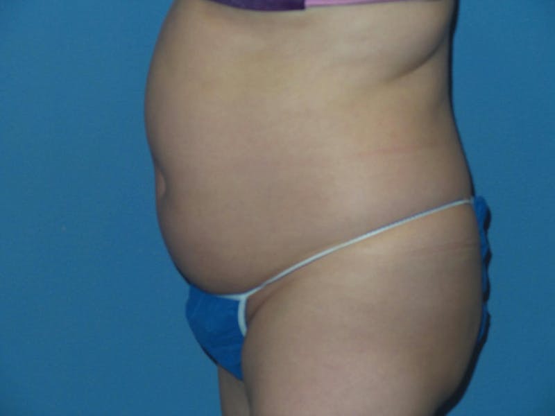 Liposuction Before & After Gallery - Patient 496043 - Image 5