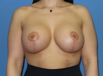 Breast Augmentation + Lift Before & After Gallery - Patient 163977 - Image 2