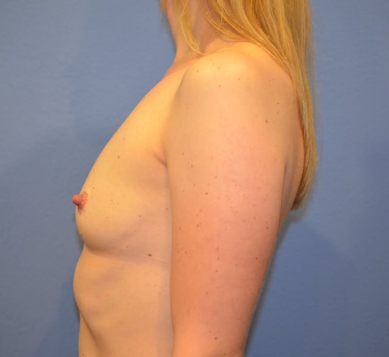 Breast Augmentation Before & After Gallery - Patient 107555 - Image 5