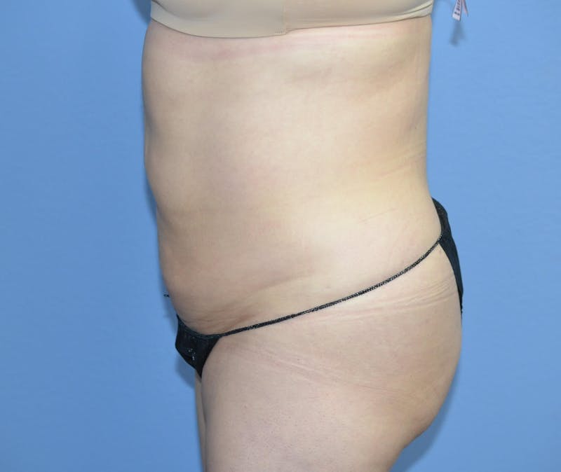 Liposuction Before & After Gallery - Patient 496043 - Image 6