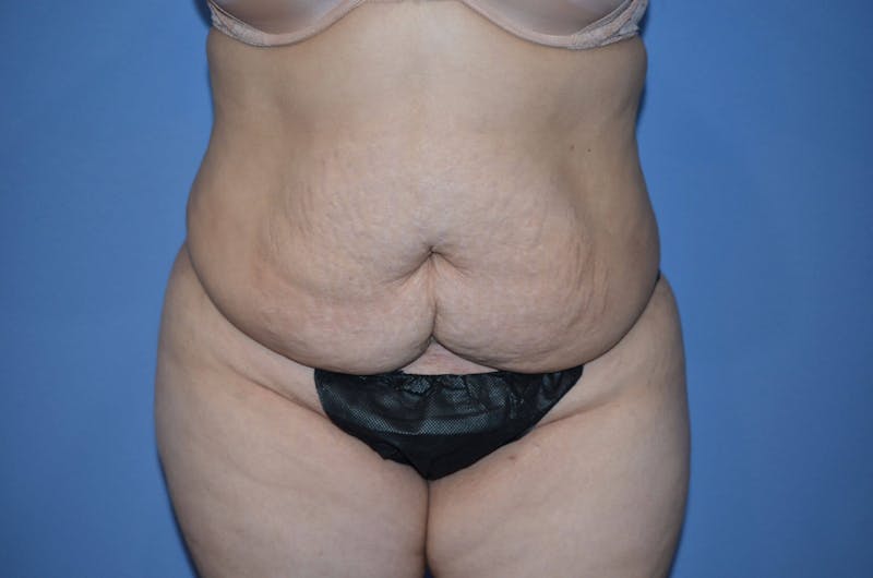 Tummy Tuck Before & After Gallery - Patient 166179 - Image 1