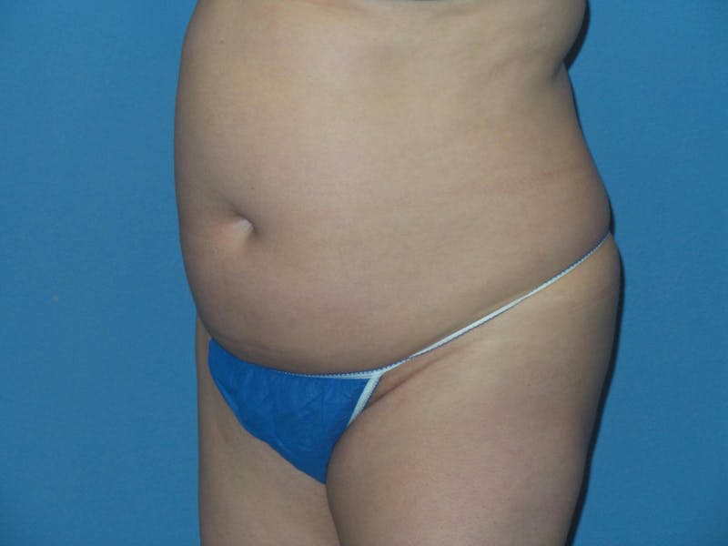 Liposuction Before & After Gallery - Patient 496043 - Image 7