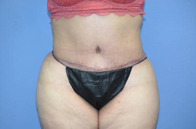 Tummy Tuck Before & After Gallery - Patient 166179 - Image 2