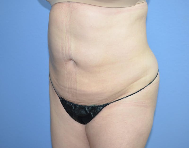 Liposuction Before & After Gallery - Patient 496043 - Image 8