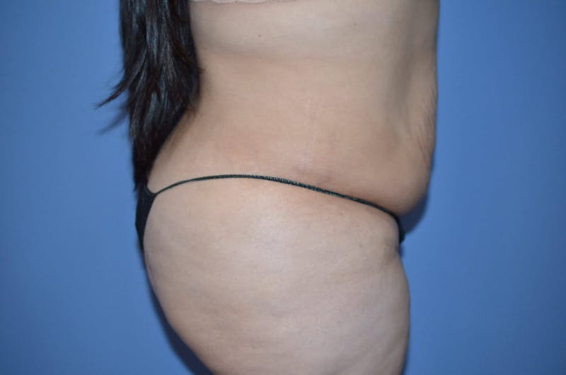 Tummy Tuck Before & After Gallery - Patient 166179 - Image 3