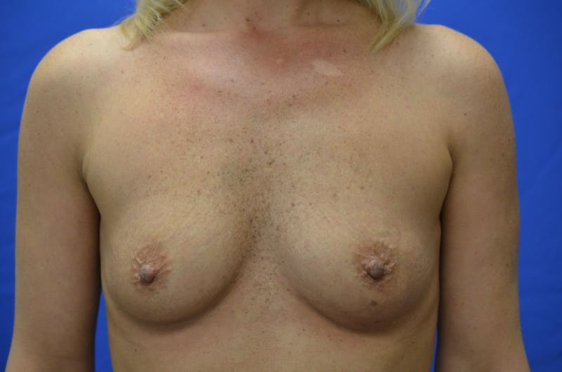 Breast Augmentation Before & After Gallery - Patient 109244 - Image 1