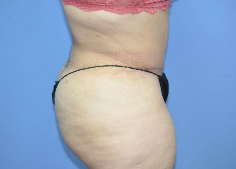 Tummy Tuck Before & After Gallery - Patient 166179 - Image 4