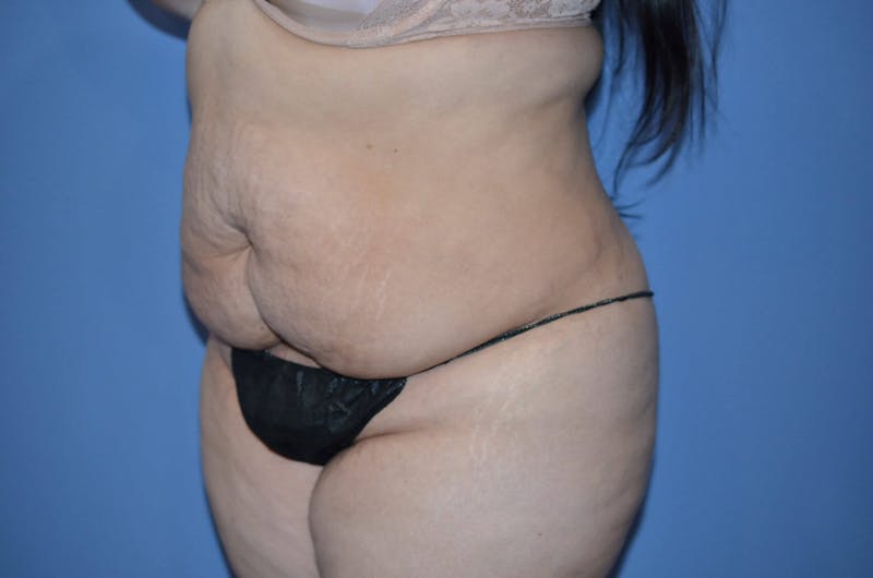 Tummy Tuck Before & After Gallery - Patient 166179 - Image 5