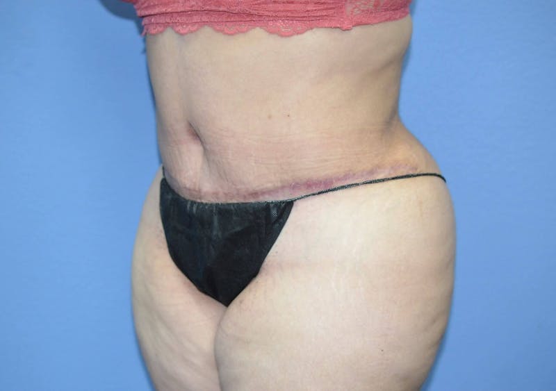 Tummy Tuck Before & After Gallery - Patient 166179 - Image 6