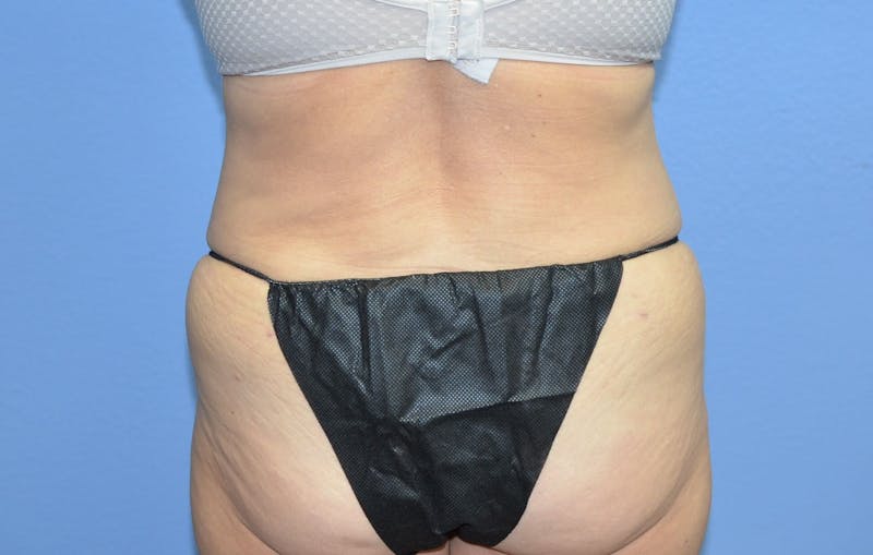 Liposuction Before & After Gallery - Patient 333540 - Image 4