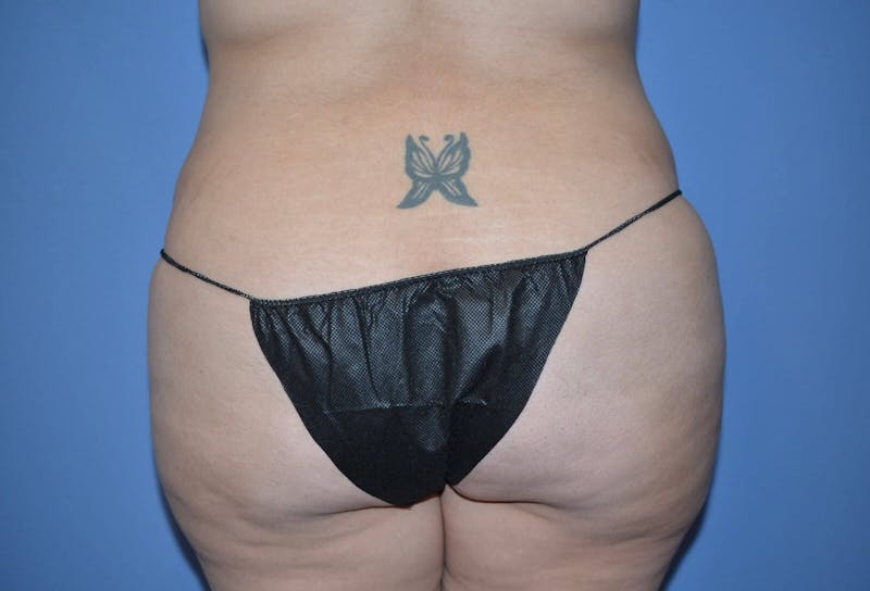 Tummy Tuck Before & After Gallery - Patient 166179 - Image 7